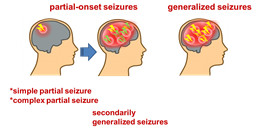 About Epilepsy