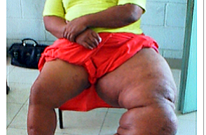 Episodes from the People Involved in the Programme to Eliminate Lymphatic Filariasis
A Story from Kiribati -“Hope”
Field Report from Prof. Ichimori, Nagasaki University